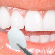 Tanden bleken bij de tandarts