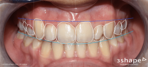 Digital smile design (DSD)