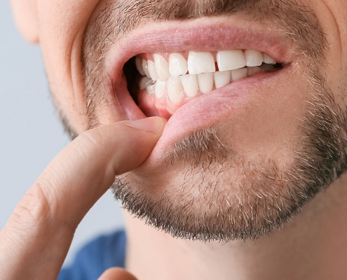 Wat te doen bij afgebroken tand